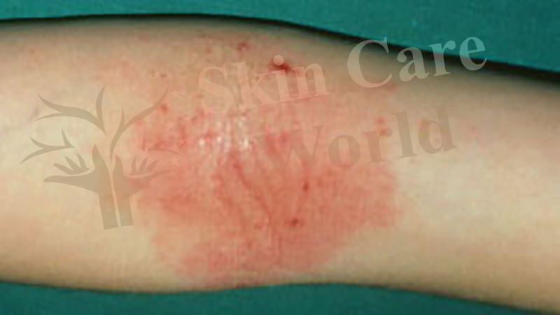 eczema on inside elbows